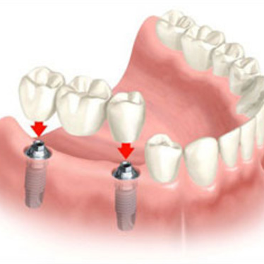 Dental Implant Bridge