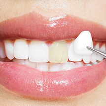 Porcelain Veneers