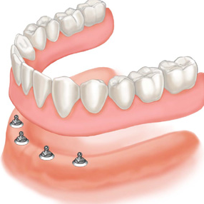 implant dentures